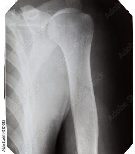 X-ray of a man's shoulder on a white