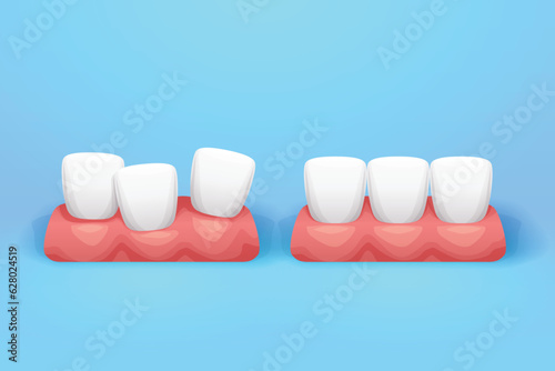 straight and crooked teeth on blue back