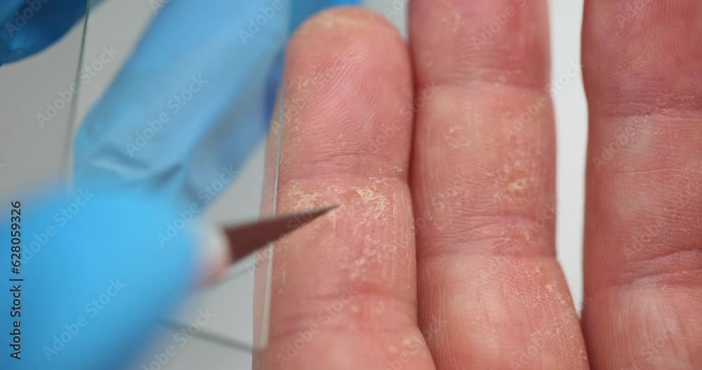 Dermatologist takes scraping from problematic skin of patient's hands