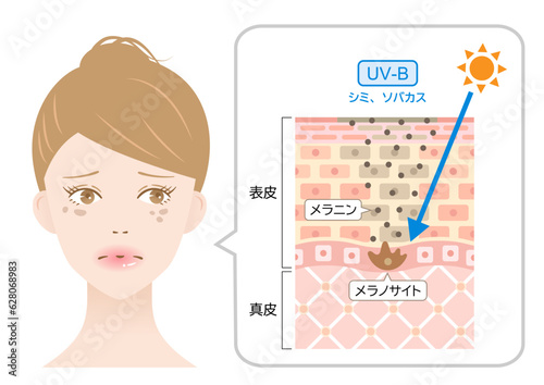 紫外線B波　シミ、ソバカス　女性と肌の断面図