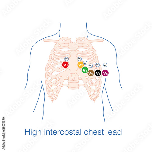 Sometimes, it is necessary to place electrodes in the high intercostal space at the conventional chest lead electrode placement position, which is called a high intercostal chest lead. photo