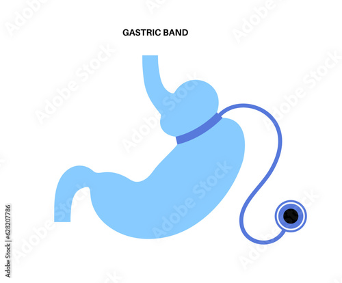Gastric band poster