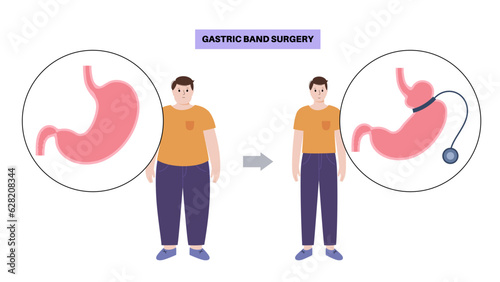 Gastric band poster