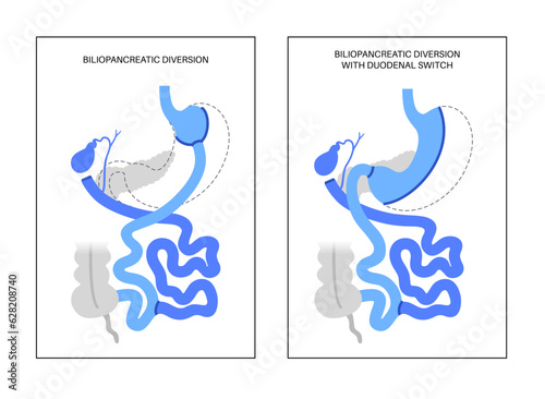 Biliopancreatic diversion procedure