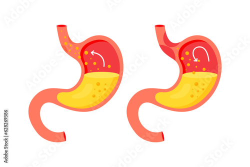 Human stomach. Organ of internal digestion system. Gastroesophageal reflux disease concept. Stomach with GERD and healthy one. Vector illustration in flat style