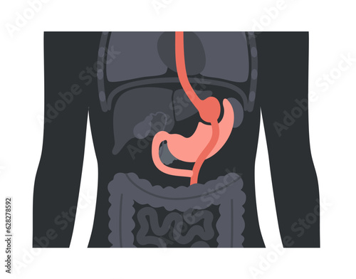Gastric bypass surgery