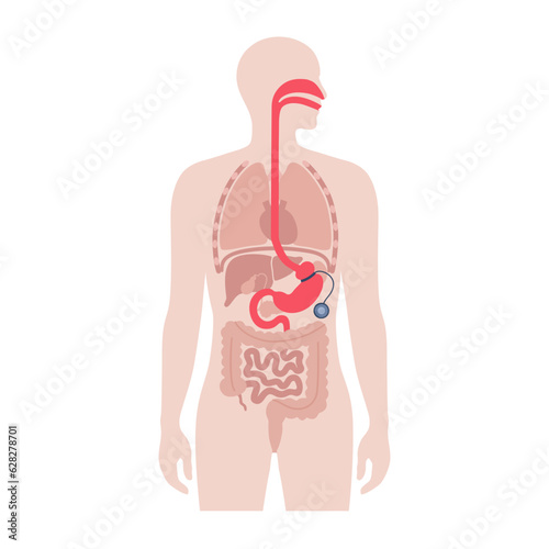 Gastric band poster