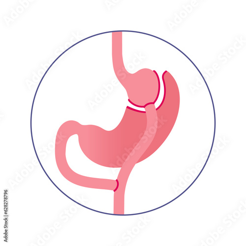 Gastric bypass surgery