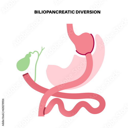 Biliopancreatic diversion procedure