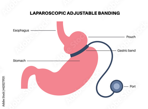 Gastric band poster