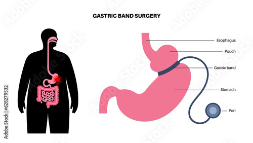 Gastric band poster