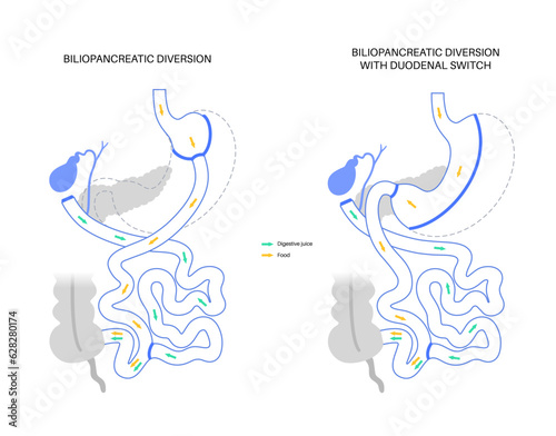 Biliopancreatic diversion procedure