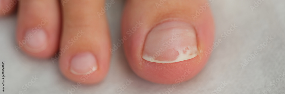 Damaged toenail close up, shallow depth of field. Damaged toenail close up, shallow depth of field.