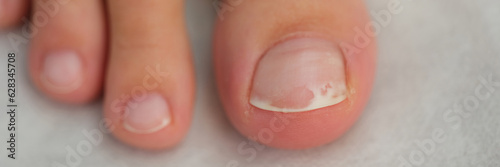 Damaged toenail close up, shallow depth of field. photo