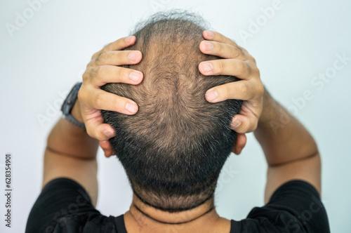 Foto Rear view of bald spot on men's head
