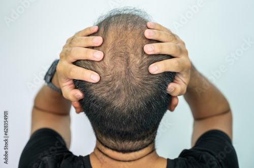 Rear view of bald spot on men's head. Baldness is related to your genes and male sex hormones. It usually follows a pattern of receding hairline and hair thinning on the crown.