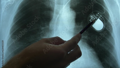 Wallpaper Mural Doctor Examining X-Ray Image of Chest with Artificial Cardiac Pacemaker Implant Torontodigital.ca