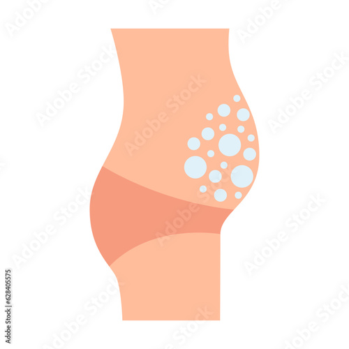 Protruding belly of human with bloating, flatulence, bubbles in tummy. Irritable bowel syndrome, IBS. Symptom in intestine and stomach. Vector photo