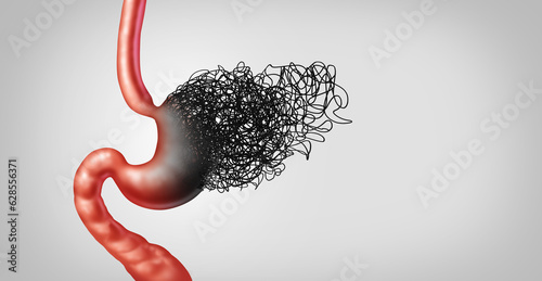 Bild auf Leinwand Stomach Disease as peptic ulcers and abdominal pain or gastritis and Gastropares