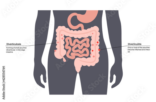 Diverticulitis and diverticulosis