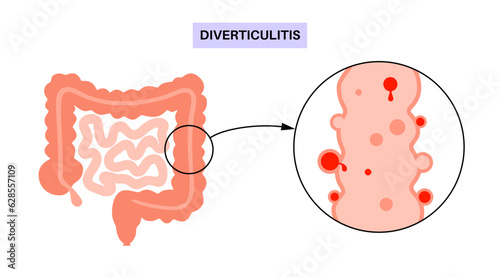 Diverticulitis and diverticulosis