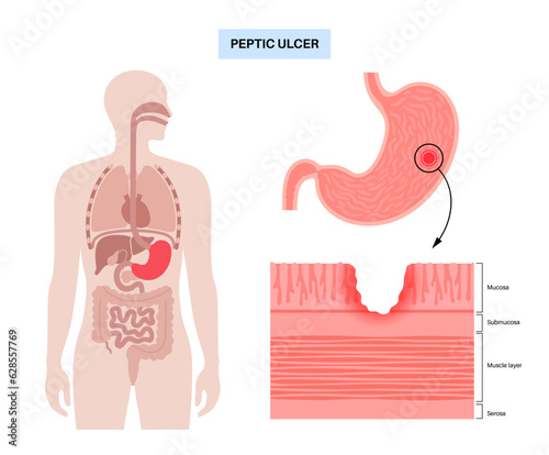 Peptic ulcer disease