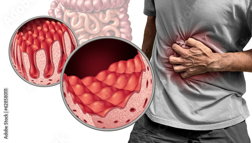 Celiac Disease or coeliac disease as an intestine anatomy medical concept with normal villi and painful damaged small bowel lining as an autoimmune disorder 