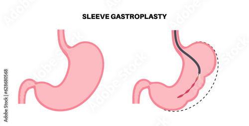 Endoscopic sleeve gastroplasty