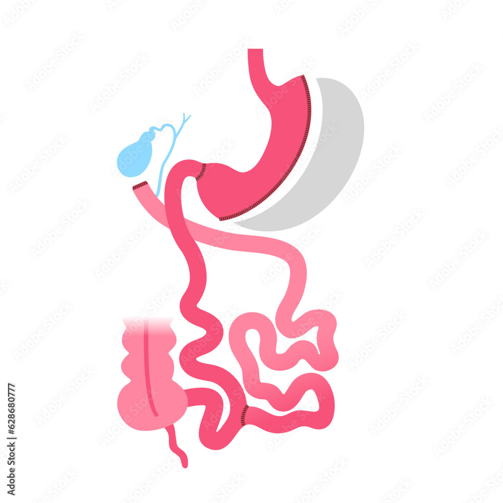 Fototapeta premium Biliopancreatic diversion procedure