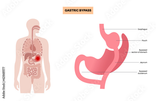 Gastric bypass surgery