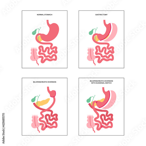 Bariatric surgery poster