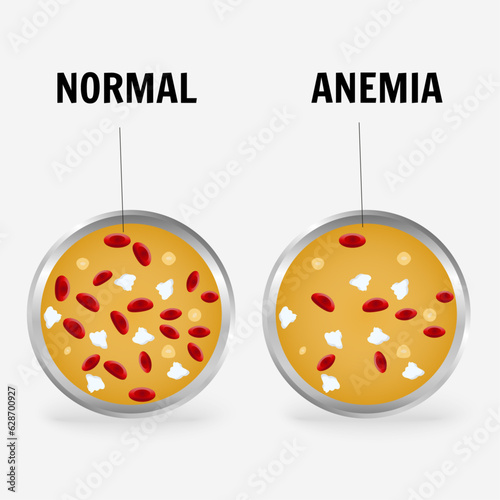 Blood test with anemia infographic in vector