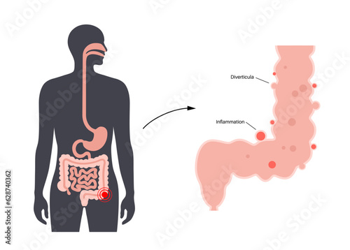 Diverticulitis and diverticulosis