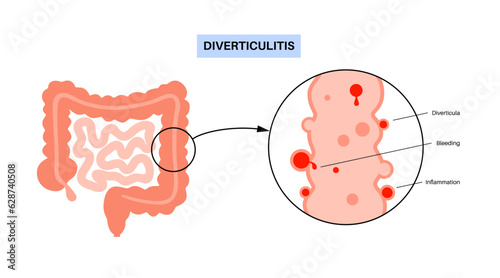 Diverticulitis and diverticulosis