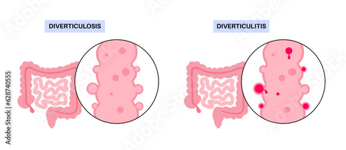 Diverticulitis and diverticulosis
