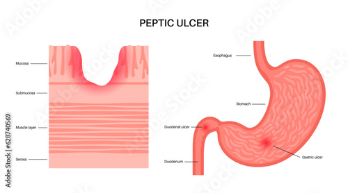 Peptic ulcer disease