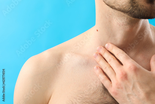 Young man with moles on blue background, closeup