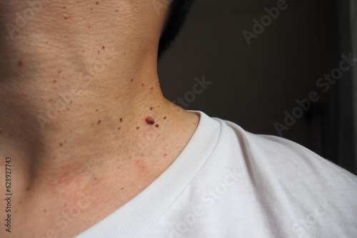 Many skin tags or Acrochordon on the neck of an Asian male. They are small soft and common benign on the human skin especially on adult skin and can be irritated by shaving and daily clothing
