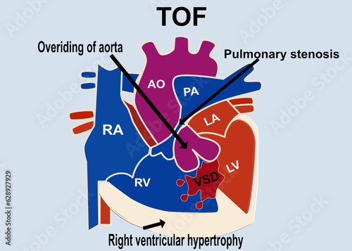 The picture show the structure of tetralogy of fallot that show the 4 part defect of heart which is overriding of aorta , pulmonary stenosis  ,VSD, right ventricular hypertrophy for medical concept photo
