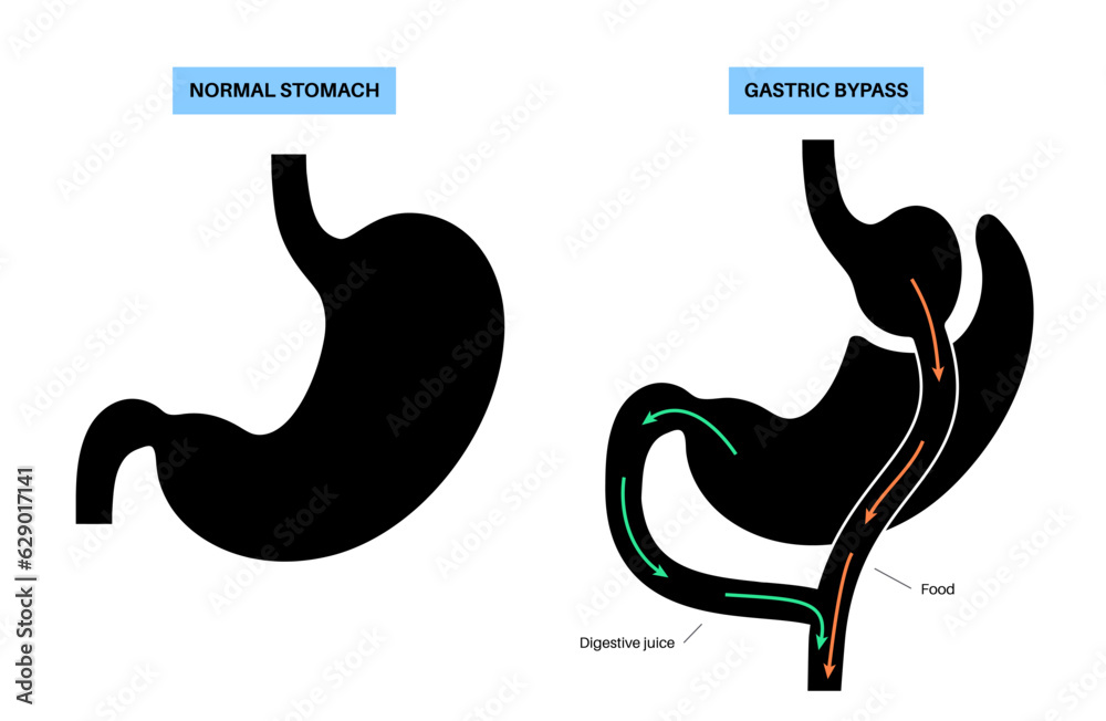 Fototapeta premium Gastric bypass surgery