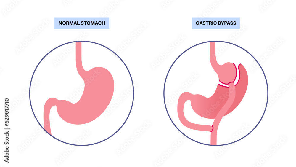Gastric bypass surgery - obrazy, fototapety, plakaty 