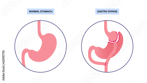 Gastric bypass surgery photo