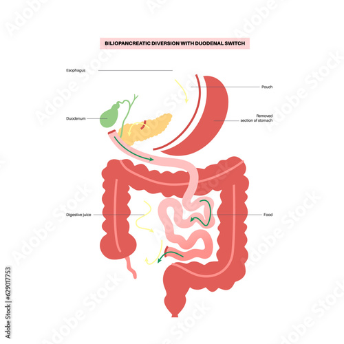 Biliopancreatic diversion procedure