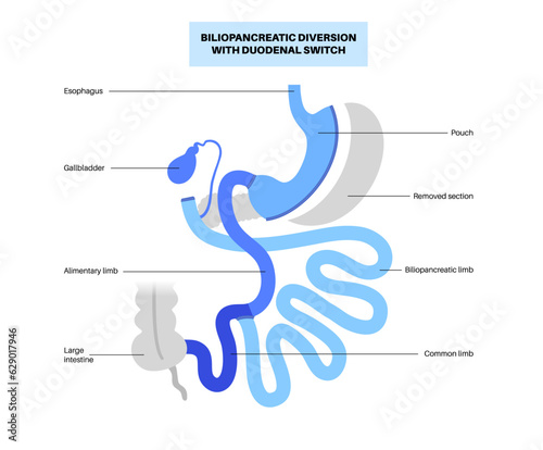 Biliopancreatic diversion procedure