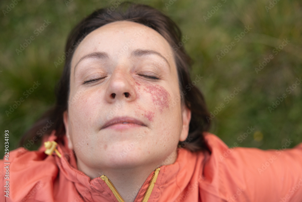 Young woman with a birthmark on her face lying with her eyes closed, the concept of unity with nature, Austria