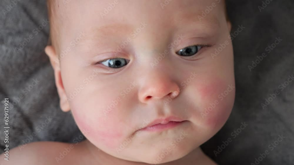 Baby girl with allergic reaction on cheekbones looks at camera. Small child with big blue eyes and red rash on cheeks portrait lying on bed closeup Baby girl with allergic reaction on cheekbones looks at camera. Small child with big blue eyes and red rash on cheeks portrait lying on bed closeup