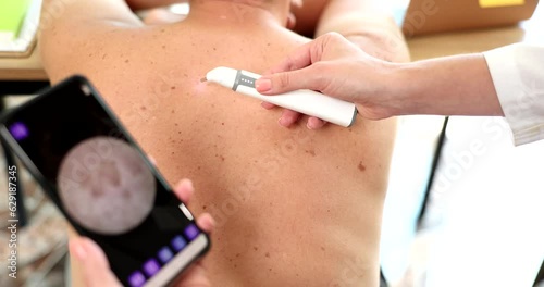 Doctor examining patient pigmented nevi using dermatoscope with mobile phone closeup 4k movie slow motion. Diagnosis and treatment of melanoma dermatoscopy concept photo