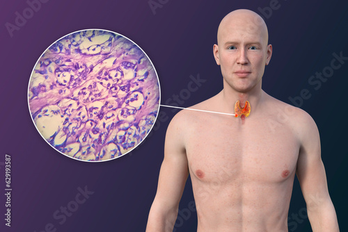 Thyroid cancer, 3D illustration