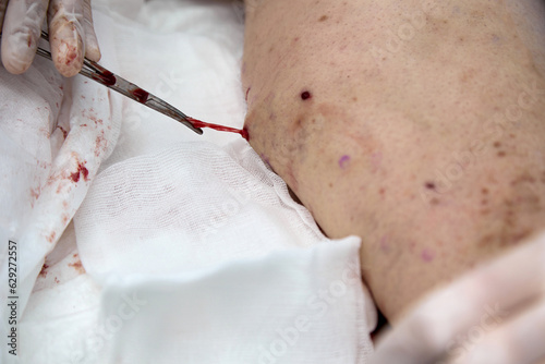 With medical forceps with scissors, the doctor gently pulls the affected vein out of a small hole in the patient's leg without an incision. Surgery to remove varicose veins on the patient's thigh