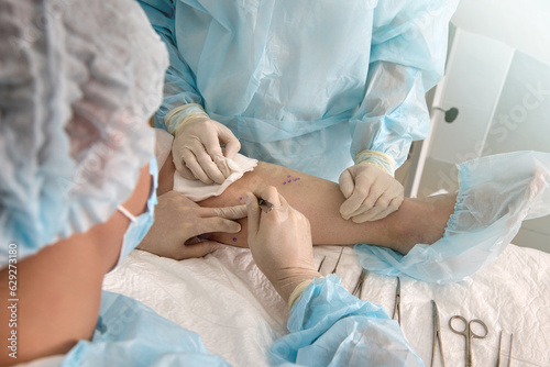 Vascular surgeon makes punctures with surgical scalpel on patient's leg at predetermined points. An experienced doctor and an assistant in operating gowns perform an operation on the patient's leg